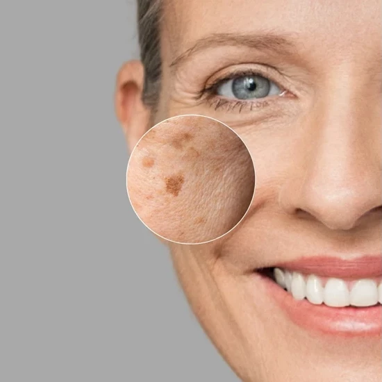 Janssen Dark Spot Perfector | Pigmentatsioonilaikudele mõeldud seerum 30 ml