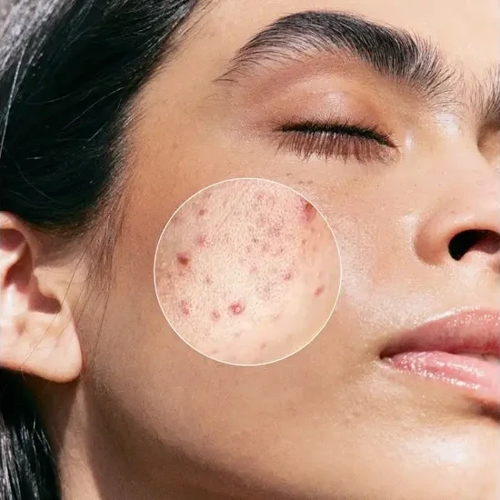 Janssen Cosmetics Purifying BHA Serum | Seerum salitsüülhappega probleemsele nahale, 30 ml
