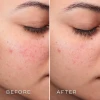Medik8 Press & Clear Refill | Заправка BHA-тоника для проблемной кожи 150 мл